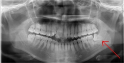 11wisdom tooth .jpg